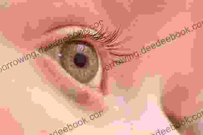 A Close Up Of An Eyelid Tumor. Eyelid Tumors: Clinical Evaluation And Reconstruction Techniques