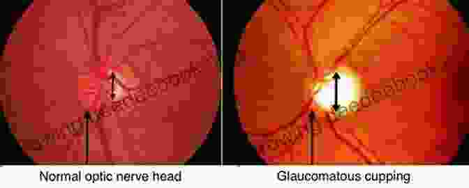 HRT Imaging Creates Topographic Maps Of The Optic Nerve Head, Detecting Structural Changes Associated With Glaucoma Glaucoma Imaging Hector Gonzalo